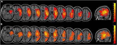 Neural substrates in patients with visual-spatial neglect recovering from right-hemispheric stroke